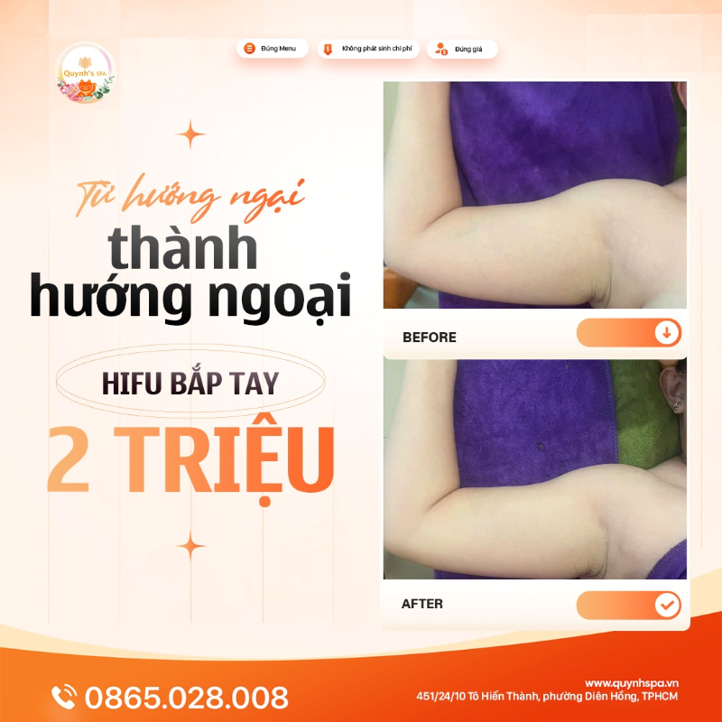 Từ "hướng ngại" thành hướng ngoại với Hifu bắp tay tại Quynh' Spa Diên Hồng