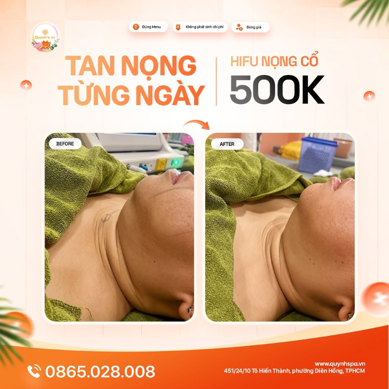 Đánh tan mỡ từng ngày với hifu nọng cổ tại Phường Diên Hồng TP.HCM