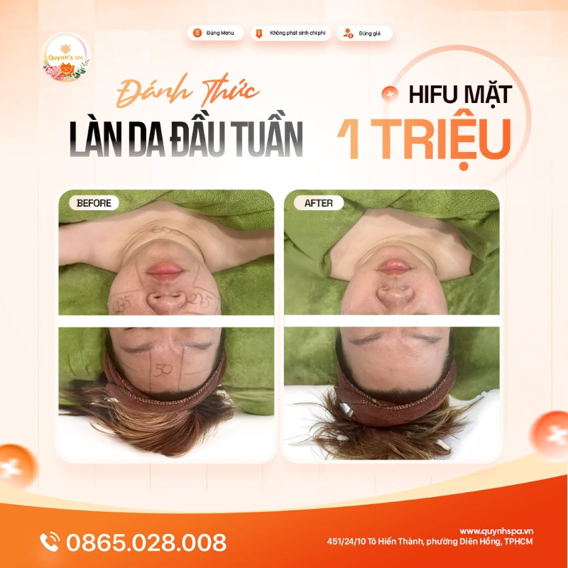 Đánh thức làn da đầu tuần với Hifu mặt tại Quynh' Spa phường Diên Hồng