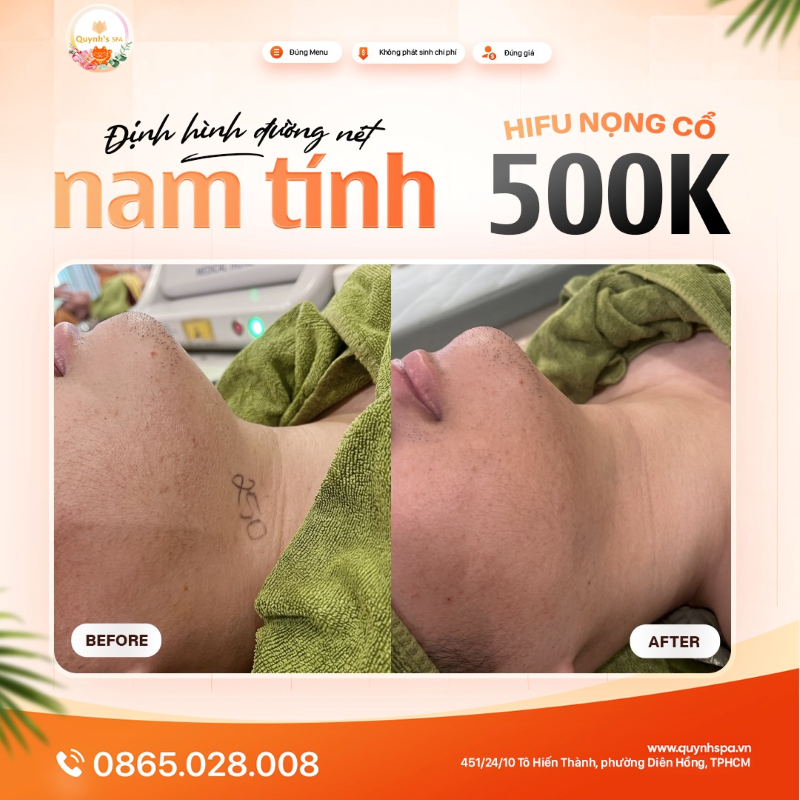 Định hình đường nét nam tính với Hifu nọng cổ tại Quynh' Spa Q.10