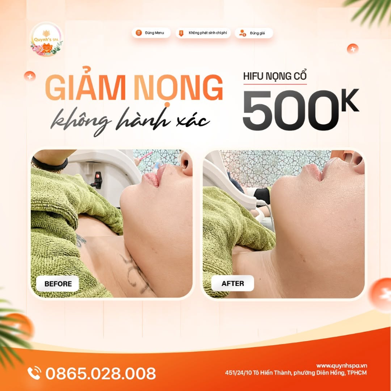 Giảm nọng không hành xác với Hifu nọng cổ tại P. Diên Hồng