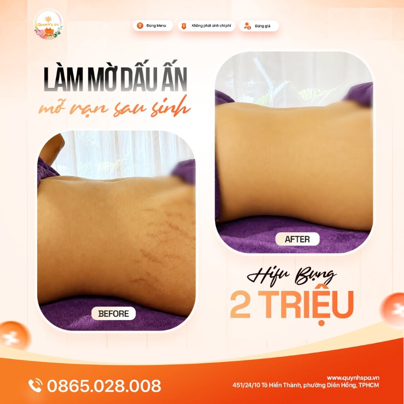 Loại bỏ dấu ấn mỡ rạn sau sinh với Hifu bụng Quynh' Spa quận 10