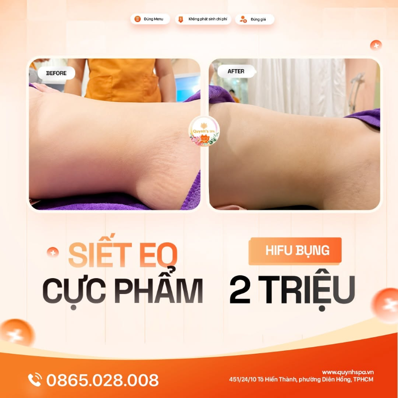 Siết eo cực phẩm với Hifu bụng tại Quynh' Spa P. Diên Hồng