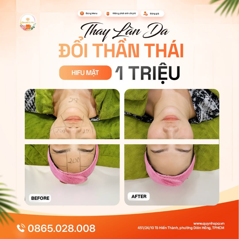 Thay đổi làn da - Cả thế giới sẽ nhìn bạn khác với hifu mặt quận 10