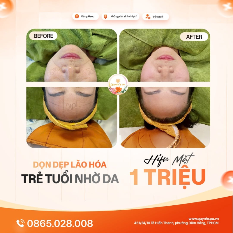 Dọn dẹp lão hóa trẻ tuổi nhờ da với Hifu trẻ hóa Quận 10