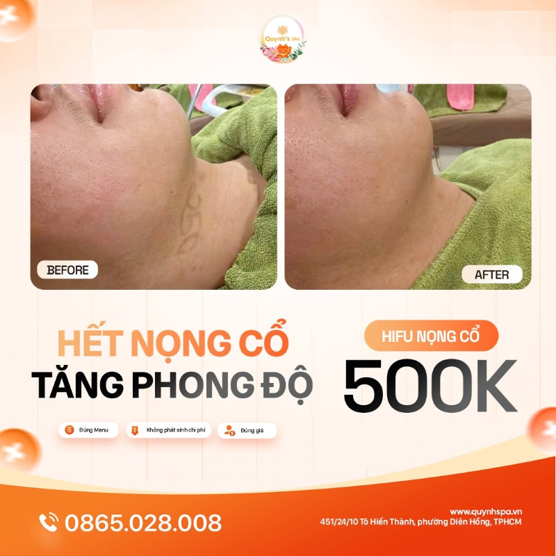 Hết Nọng Cổ - Tăng Phong Độ với Hifu nọng cổ P. Diên Hồng