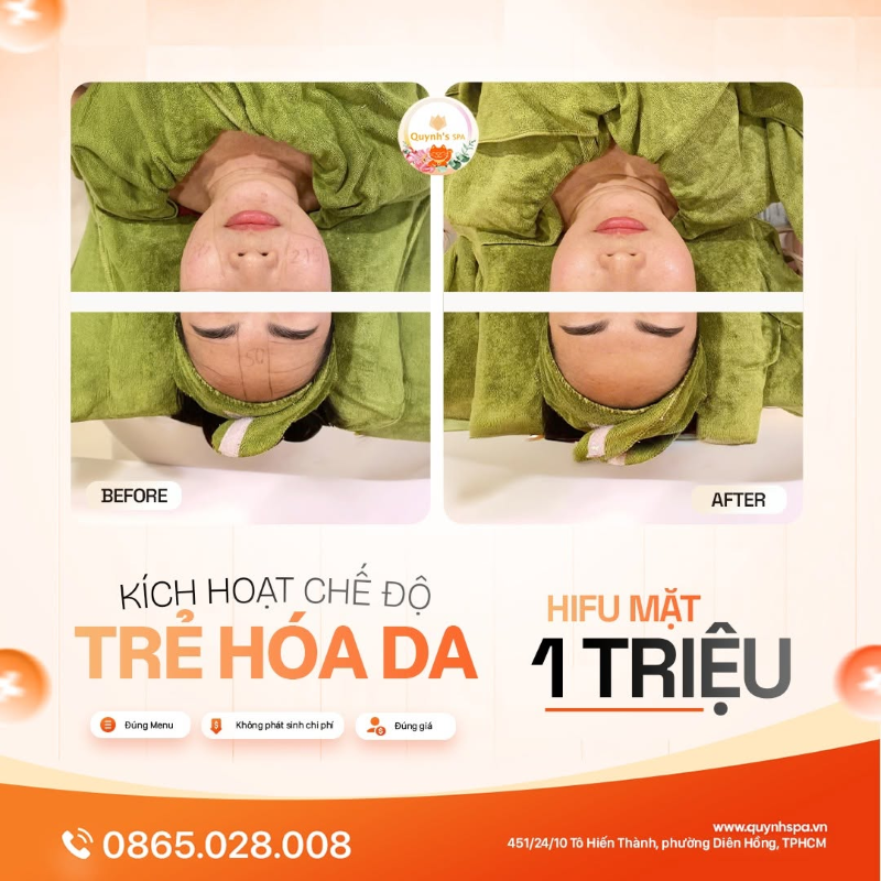 Kích hoạt chế độ trẻ hóa da với Hifu mặt tại Quynh' Spa quận 10