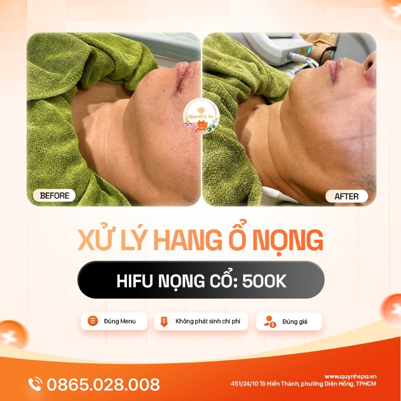Xử lý hang ổ nọng với HIFU nọng cổ tại Quỳnh Spa quận 10