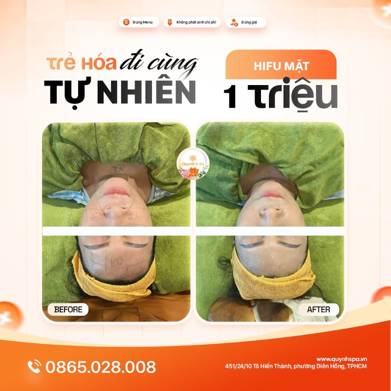 Đã trẻ hóa phải đi cùng tự nhiên với HIFU mặt tại Quỳnh Spa quận 10