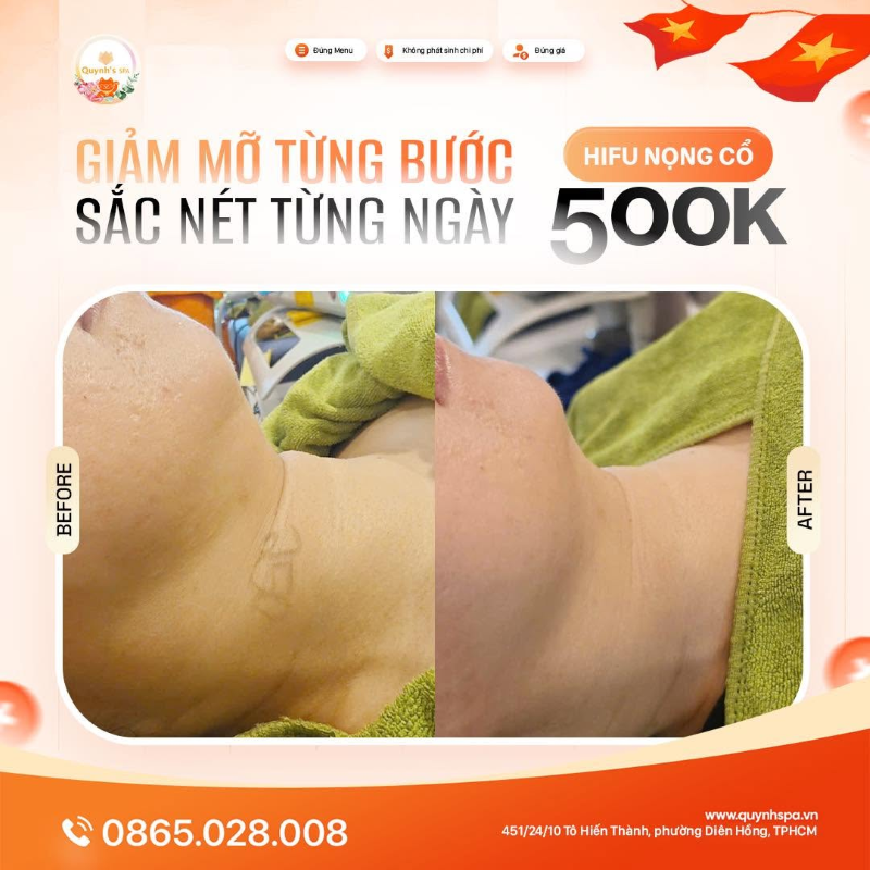 Giảm mỡ từng bước - Sắc nét từng ngày với HIFU nọng cổ tại Quỳnh Spa phường Diên Hồng