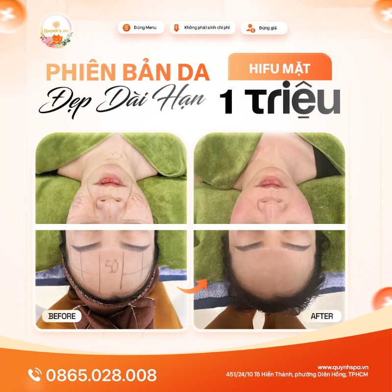 Không chỉ đẹp tức thì, mà phải là đẹp dài hạn với HIFU mặt tại Quỳnh Spa P. Diên Hồng