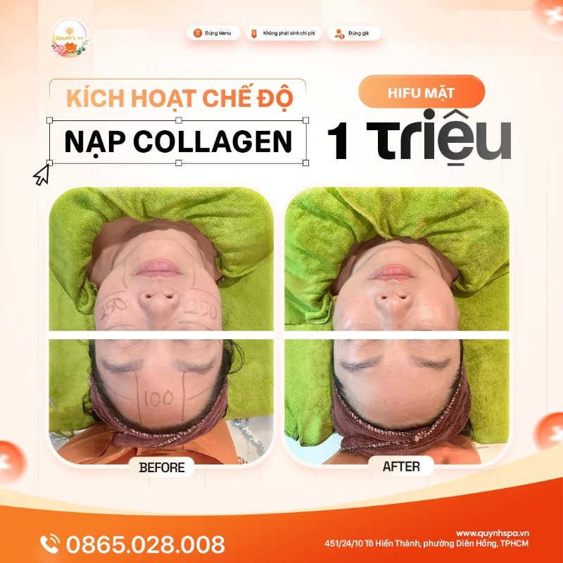 Kích hoạt chế độ nạp collagen với HIFU mặt tại Quỳnh Spa phường Diên Hồng