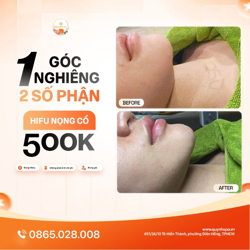Một góc mặt nhưng hai số phận với HIFU nọng cổ tại Quỳnh Spa phường Diên Hồng