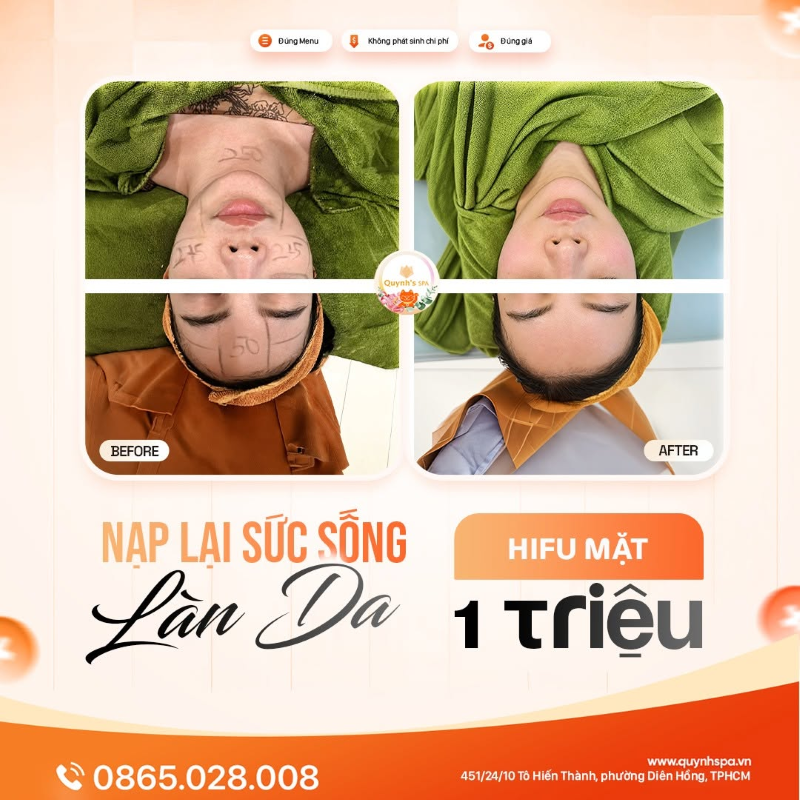 Nạp lại sức sống cho da với HIFU mặt tại Quỳnh Spa quận 10