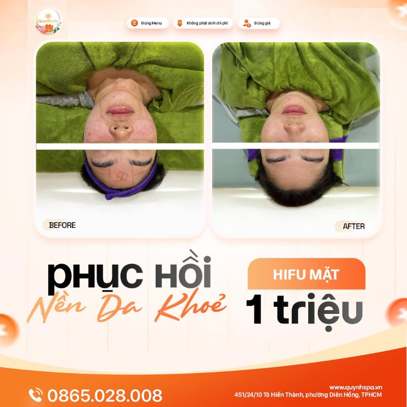 Phục hồi nền da khỏe với HIFU mặt tại Quỳnh Spa P. Diên Hồng