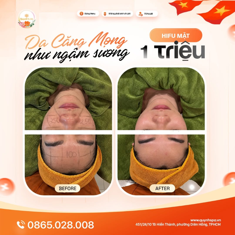 Da ngậm sương thật rồi với HIFU mặt tại Quỳnh Spa phường Diên Hồng