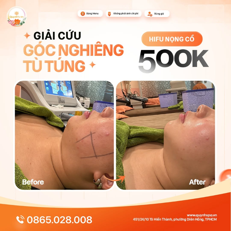 Giải cứu góc nghiêng khỏi nọng tù túng với HIFU nọng cổ tại Quỳnh Spa phường Diên Hồng