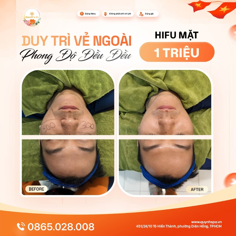 Giữ vẻ ngoài phong độ đều đều với HIFU mặt tại Quỳnh Spa quận 10 Giữ vẻ ngoài phong độ đều đều với HIFU mặt tại Quỳnh Spa quận 10