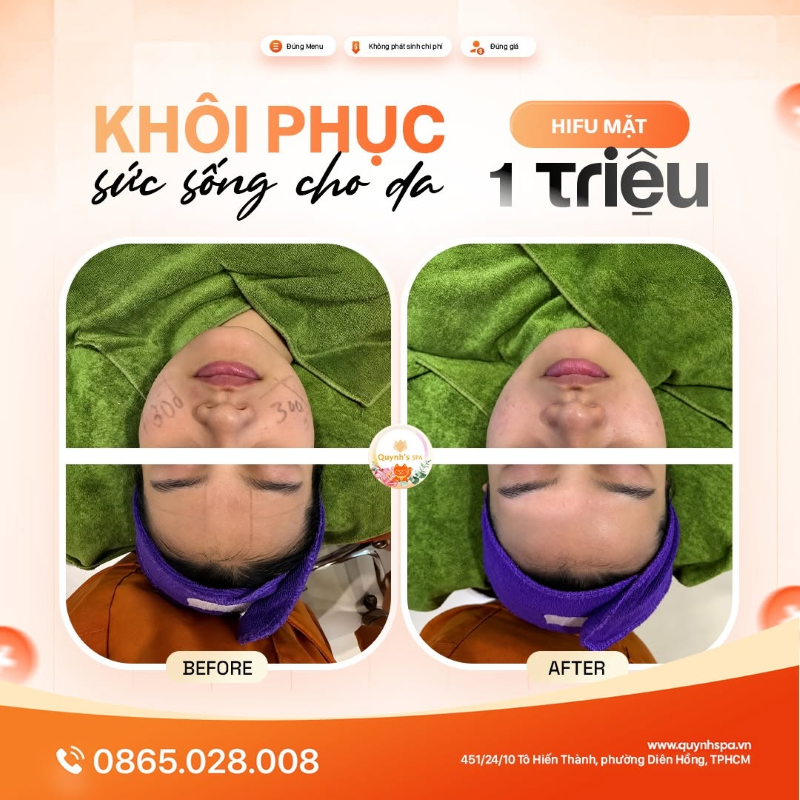 Khôi phục sức sống cho da với HIFU mặt tại Quỳnh Spa P. Diên Hồng