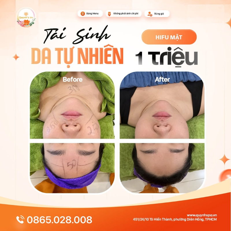 Tái sinh da tự nhiên với Hifu mặt tại Quỳnh Spa Quận 10