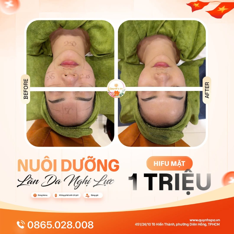 Thế nào là một làn da nghị lực với HIFU mặt tại Quỳnh Spa phường Diên Hồng